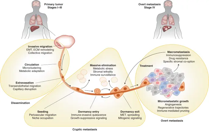 Cancer metastases to the bone &#8211; treatment, consequences