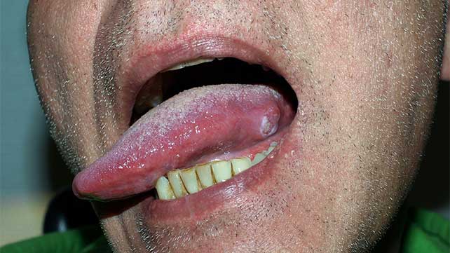 Cancer de la langue – causes, premiers symptômes, diagnostic et traitement