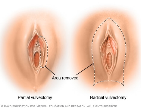 Cancer of the vulva &#8211; what tests should be done to rule out cancer?