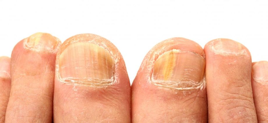 Candidiasis of nail plates and shafts &#8211; causes, symptoms, diagnosis and treatment