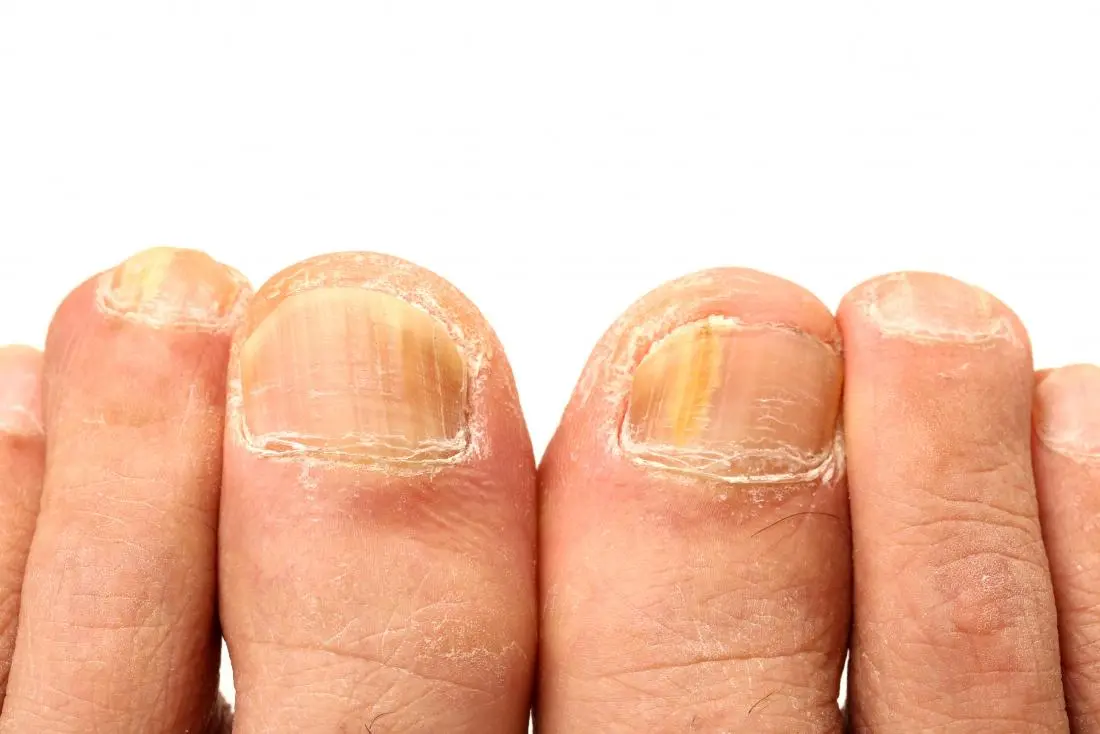 Candidiasis of nail plates and shafts &#8211; causes, symptoms, diagnosis and treatment