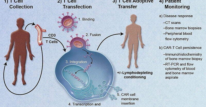 CAR-T therapy reimbursed from September 1 for B-cell acute lymphoblastic leukemia