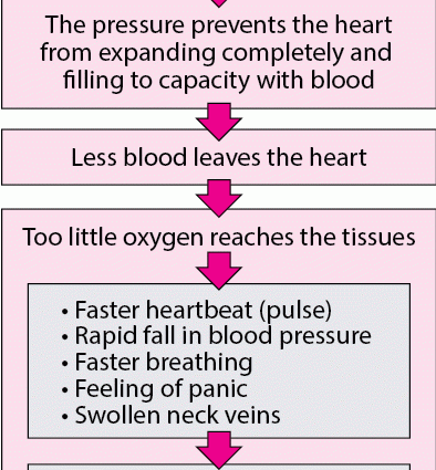 Cardiac tamponade &#8211; causes, symptoms. First aid for cardiac tamponade