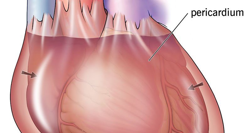 Cardiac tamponade &#8211; course, causes, symptoms, treatment