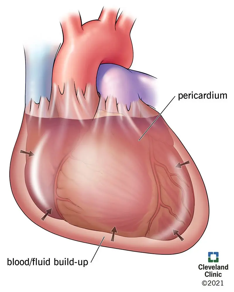 Cardiac tamponade &#8211; course, causes, symptoms, treatment