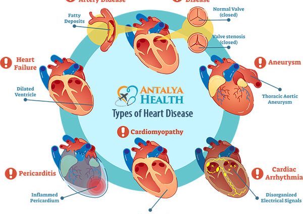 Cardiovascular disease