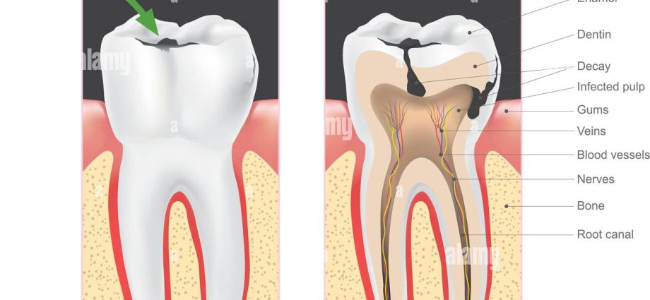 Caries destroys the entire body