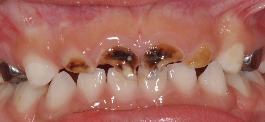 Caries in children. Causes, Symptoms and Treatment