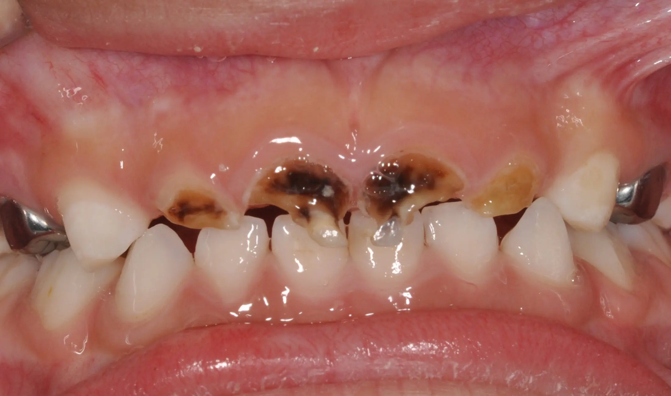 Caries in children. Causes, Symptoms and Treatment