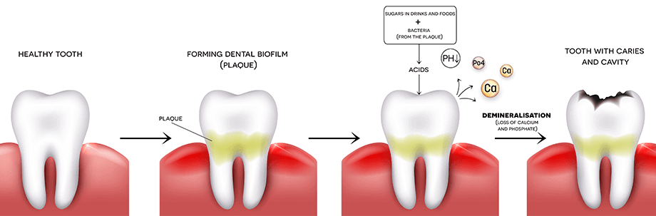 Caries is dangerous not only for the teeth