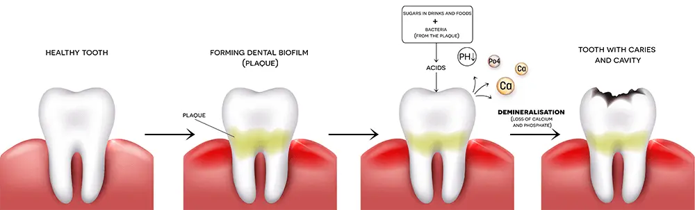 Caries is dangerous not only for the teeth