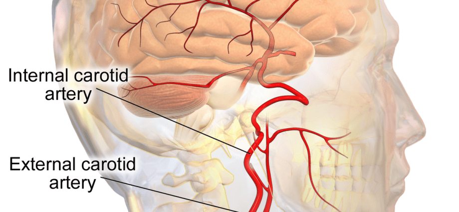 Carotid artery