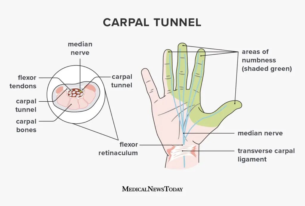 Carpal tunnel syndrome &#8211; causes, symptoms, treatment and prevention. When is surgery necessary?