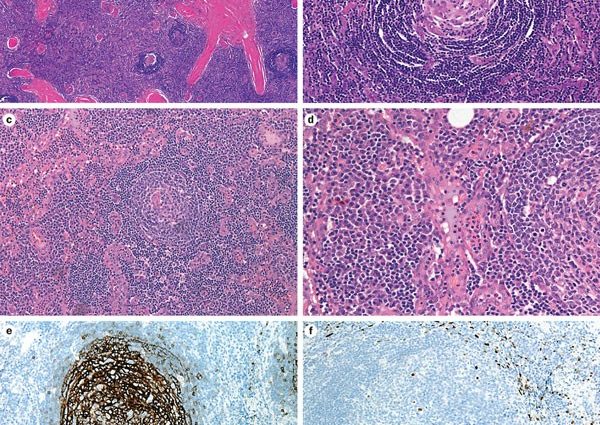 Castelman&#8217;s disease &#8211; a form of the disease. Ways to treat lymph node hyperplasia and benign lymphomas