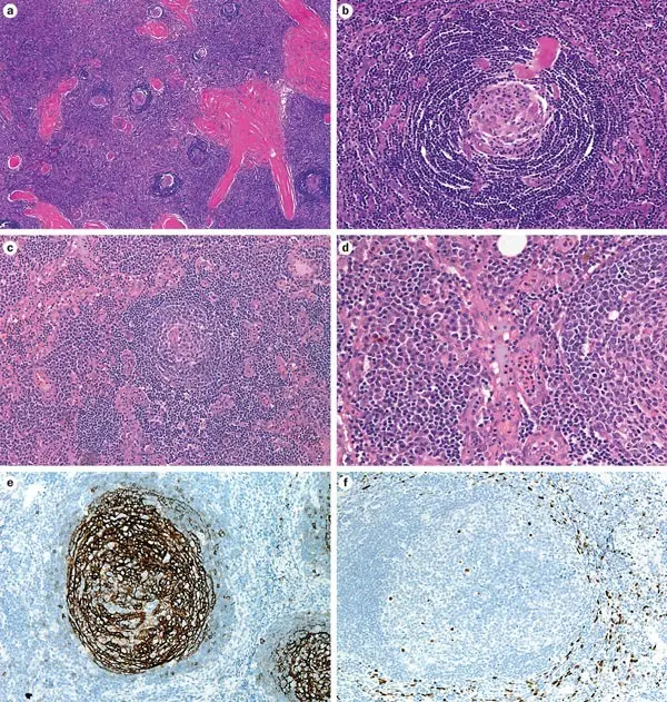 Castelman&#8217;s disease &#8211; a form of the disease. Ways to treat lymph node hyperplasia and benign lymphomas