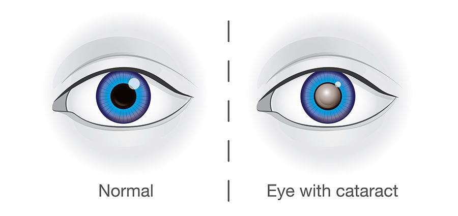 Cataract (cataract)