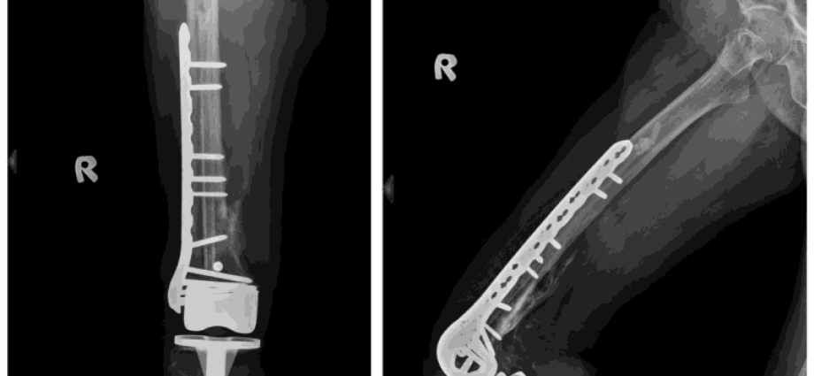 Cataract surgery protects against fracture of the femur