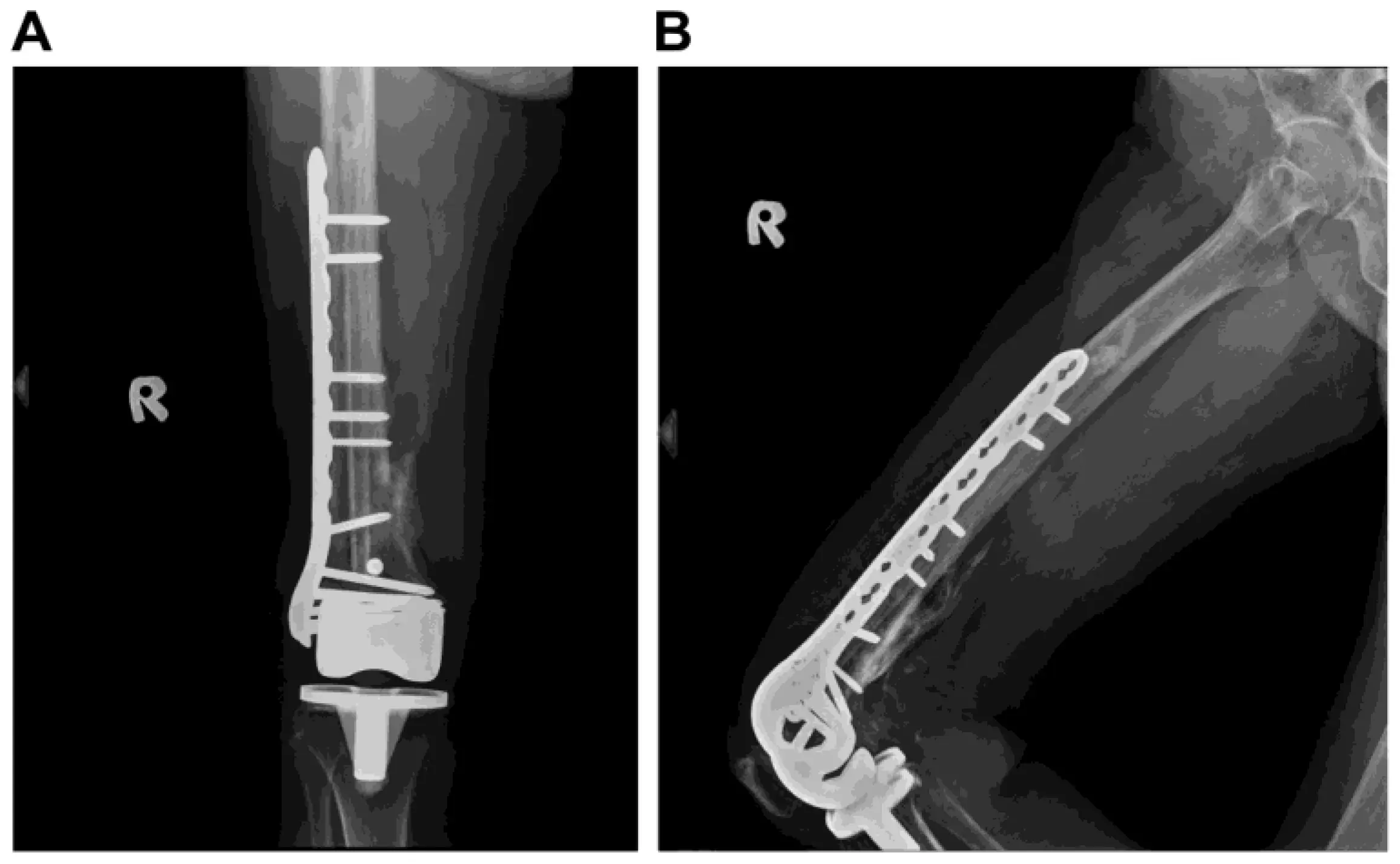 Cataract surgery protects against fracture of the femur