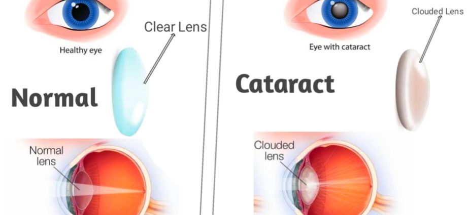 Cataracts (cataracts) &#8211; causes, symptoms, types, treatment