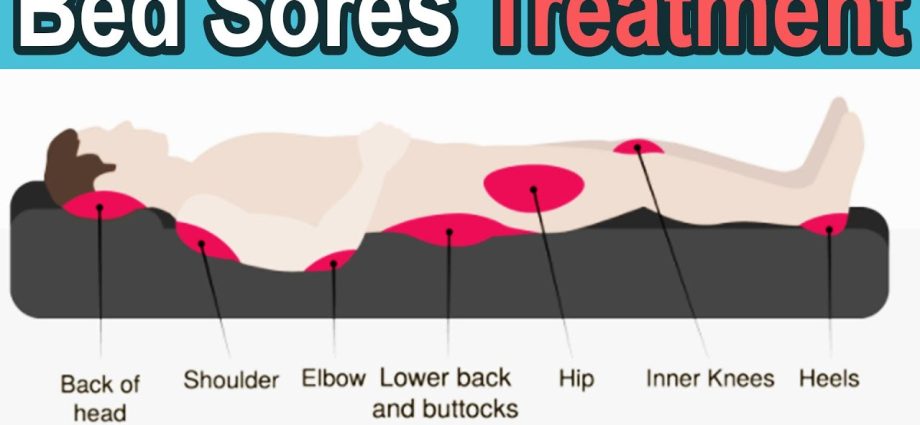 Catrix for bedsores and ulcers. How to use?