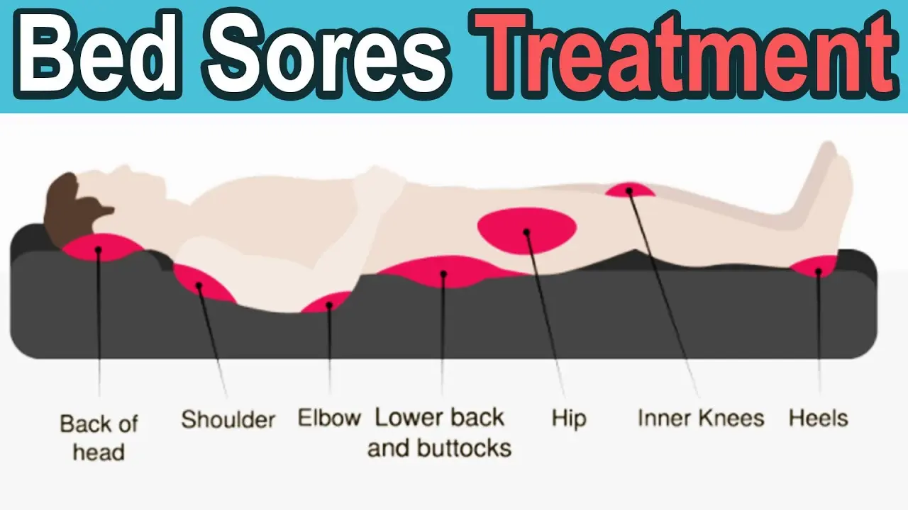 Catrix for bedsores and ulcers. How to use?