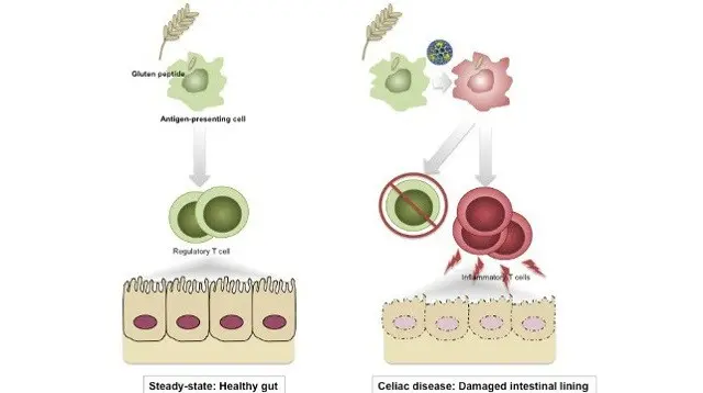 Celiac disease is caused by a virus?