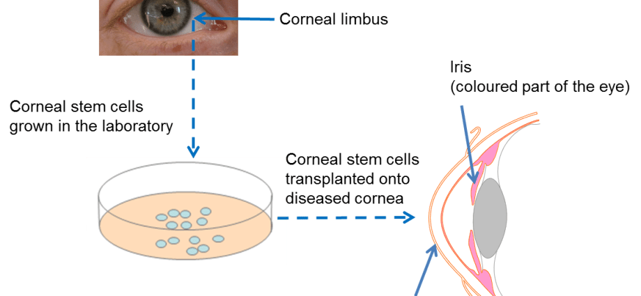 Cells taken from the eyes of people who have died can help treat blindness