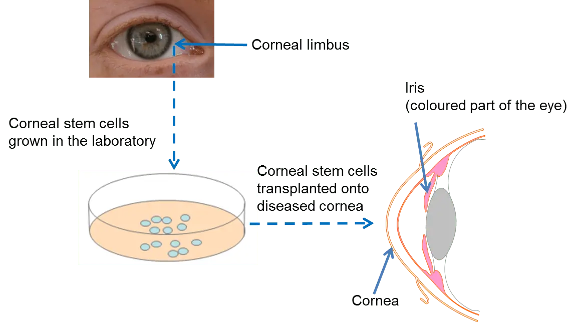 Cells taken from the eyes of people who have died can help treat blindness