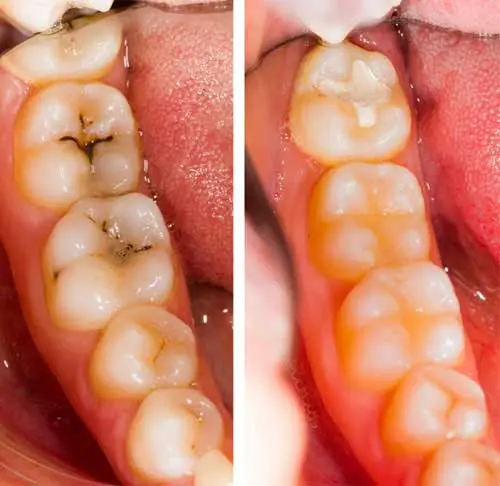 Cement fillings &#8211; how are they different from other dental fillings?