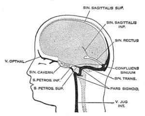 Cerebral vein sinus thrombosis &#8211; what is it? [WE EXPLAIN]