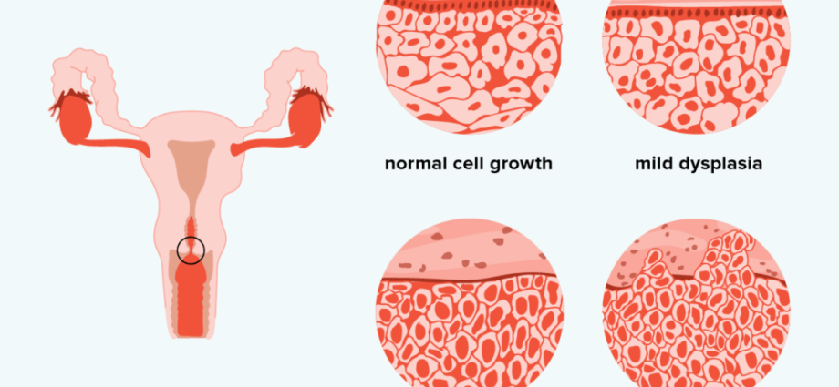 Cervical dysplasia &#8211; causes, symptoms, treatment, prevention