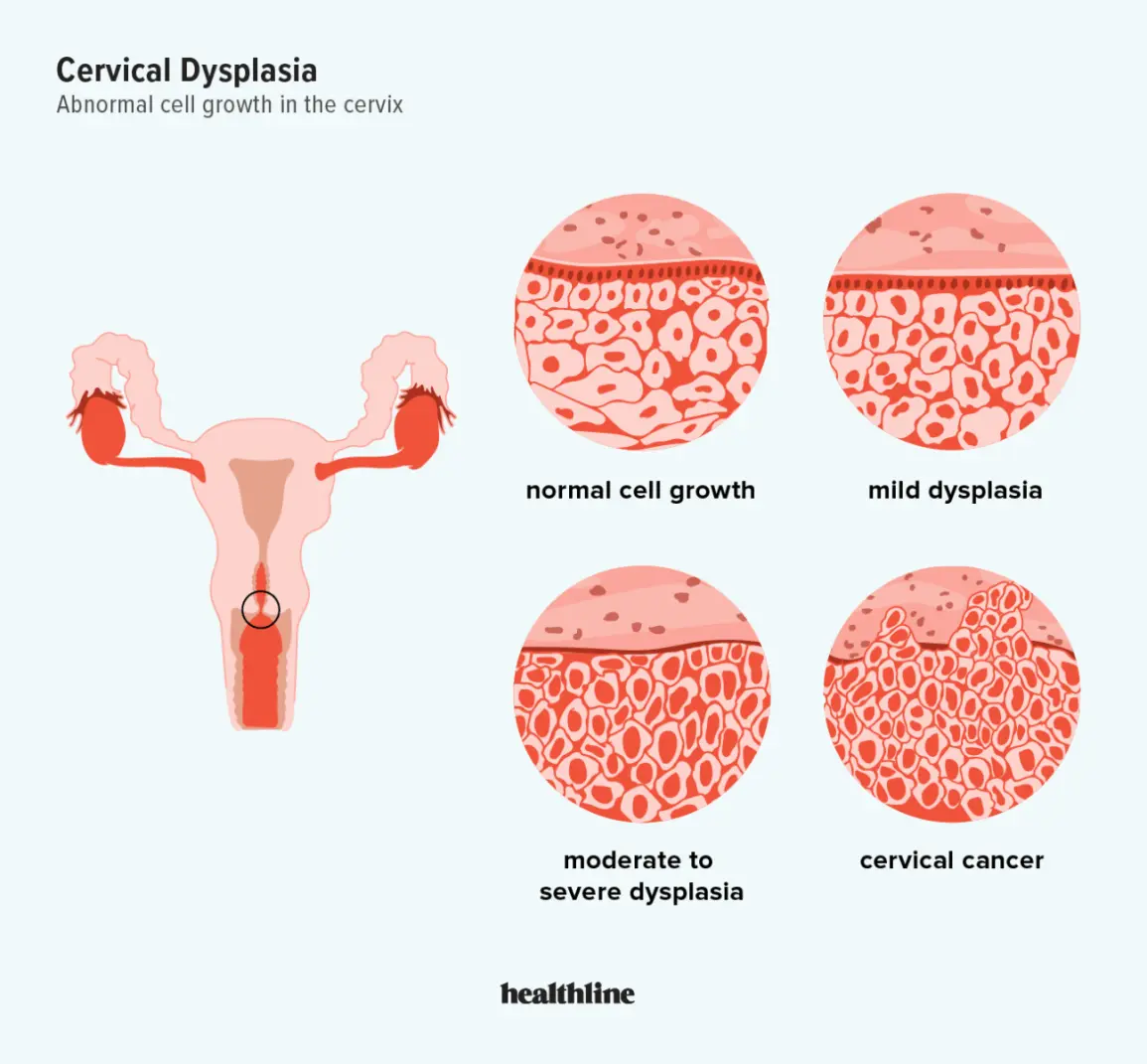 Cervical dysplasia &#8211; causes, symptoms, treatment, prevention