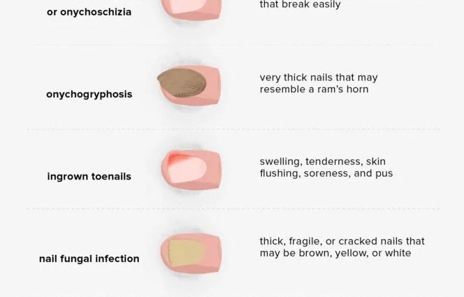 Changes in the appearance of nails &#8211; are they a symptom of a disease?