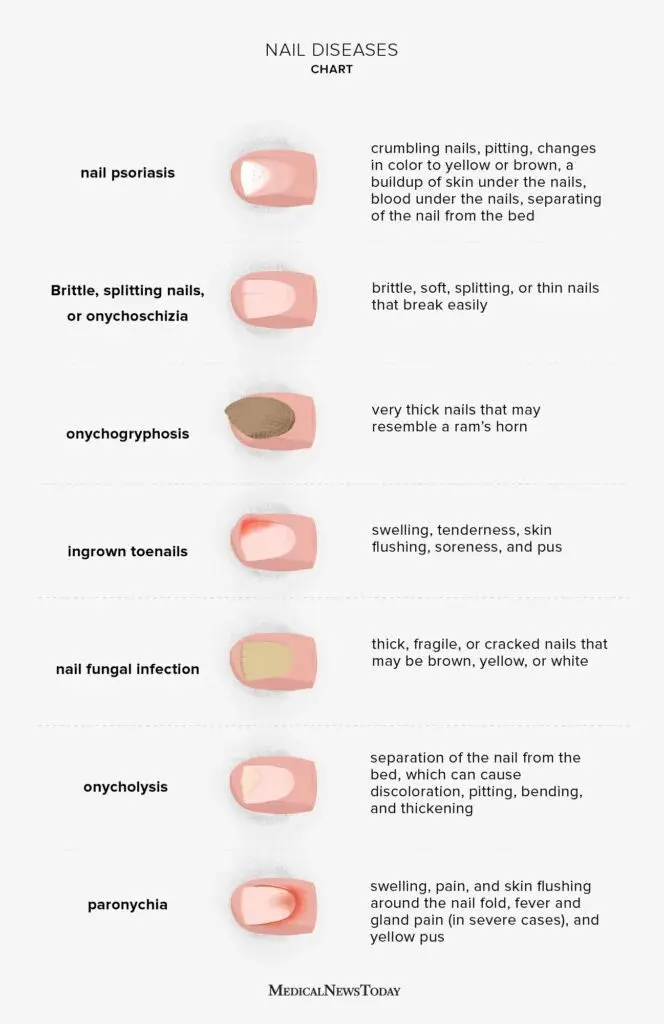 Changes in the appearance of nails &#8211; are they a symptom of a disease?