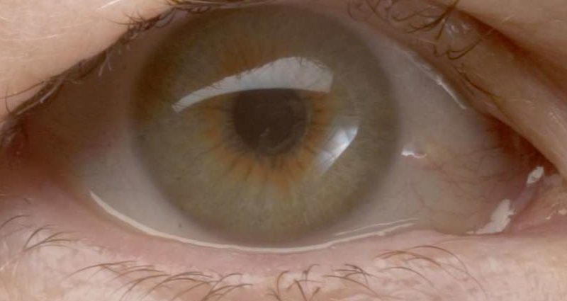 Changes in the eyelids. Eyelid spasms, drooping eyelid, yellow tufts