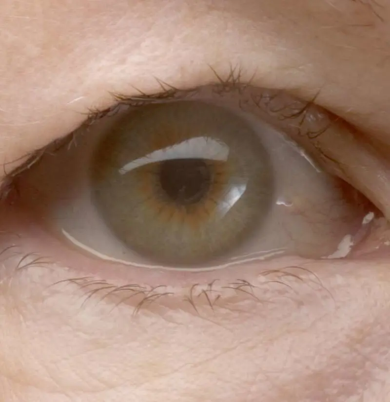 Changes in the eyelids. Eyelid spasms, drooping eyelid, yellow tufts