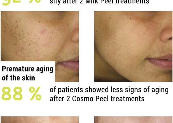 Chemical peeling &#8211; indications, types of peels, the course of the treatment