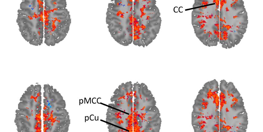 Chemistry that causes autism