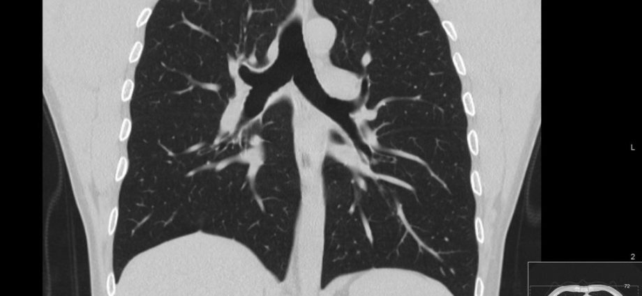 Chest computed tomography &#8211; how to interpret the results?