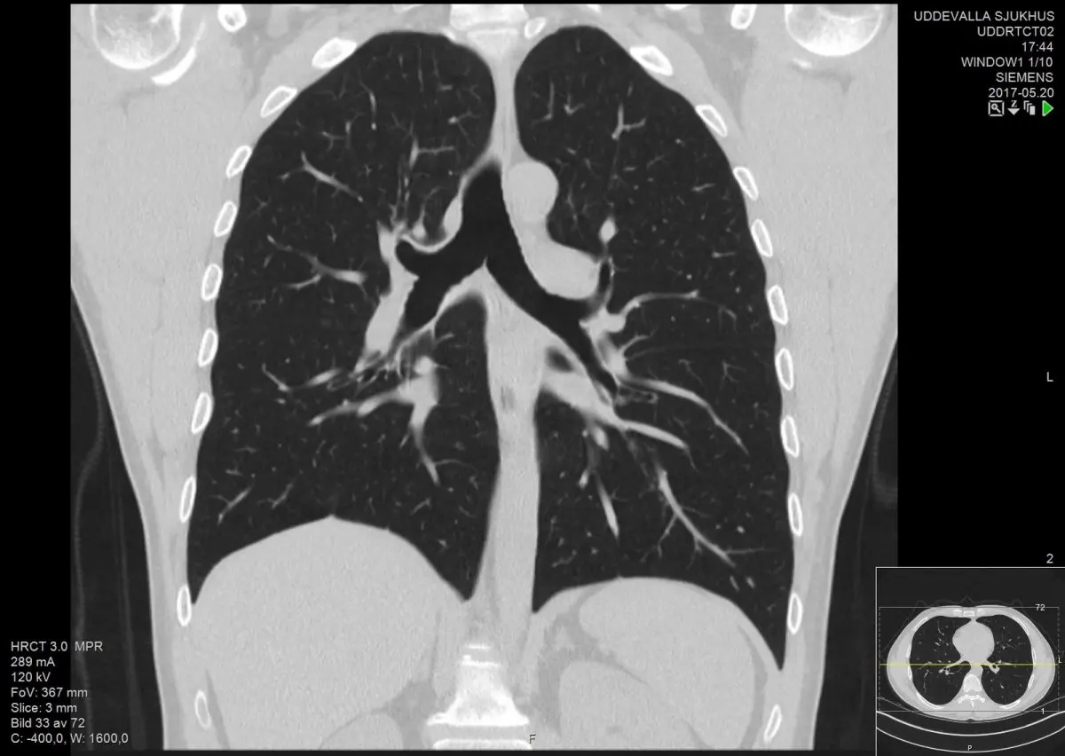 Chest computed tomography &#8211; how to interpret the results?