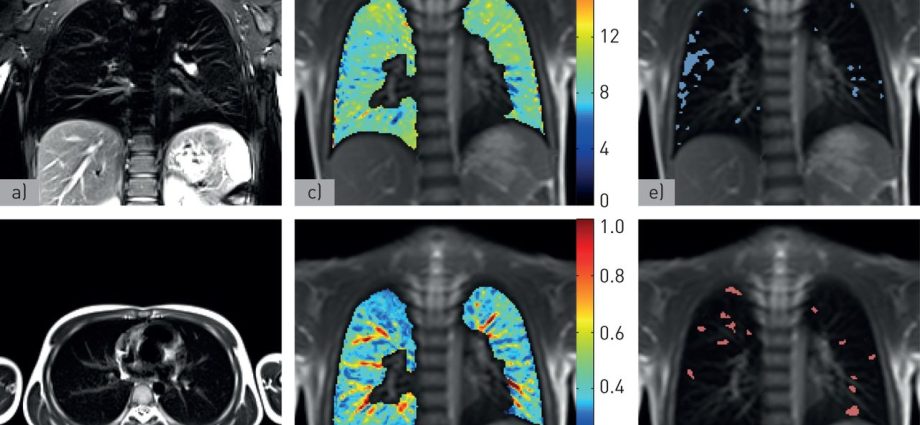 Chest magnetic resonance imaging &#8211; what is it and when to do it?