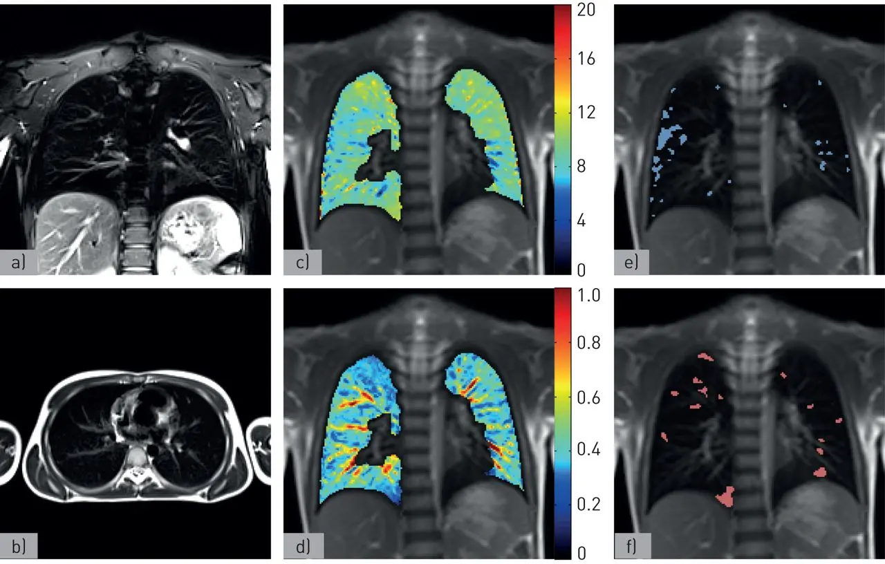 Chest magnetic resonance imaging &#8211; what is it and when to do it?