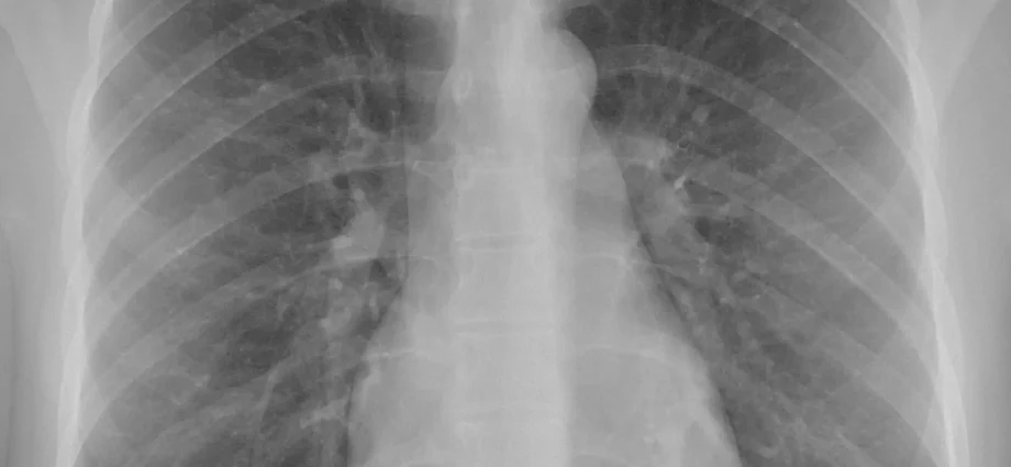 Chest X-ray (chest X-ray)