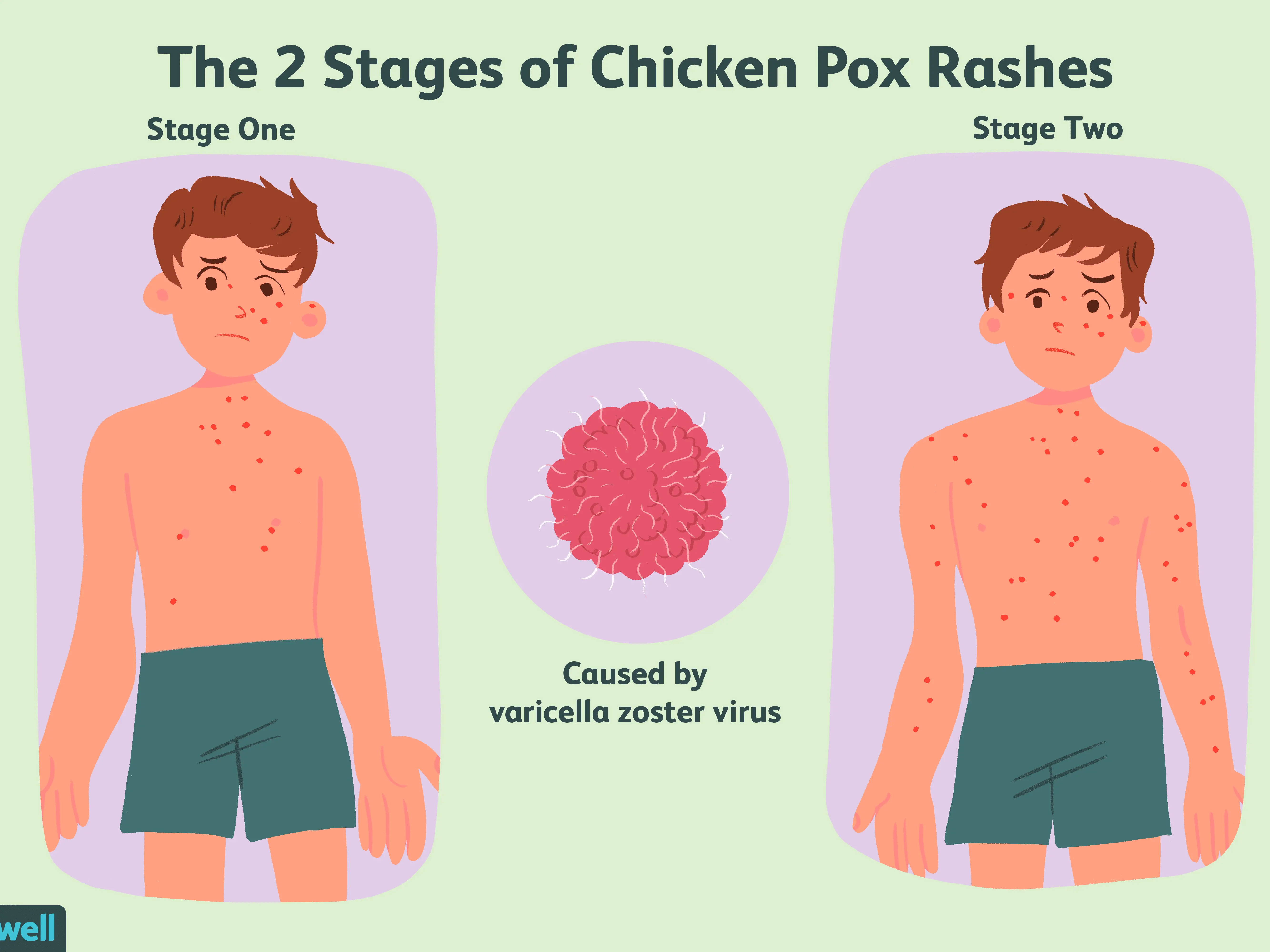 Chickenpox &#8211; how to care for and get rid of skin lesions?