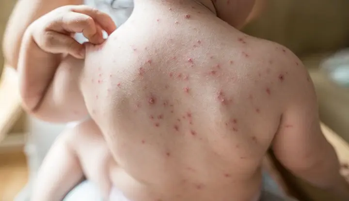 Chickenpox &#8211; symptoms, diagnosis, treatment, ways to get rash