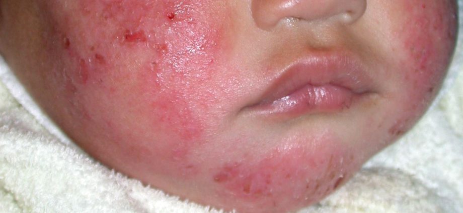 Children with eczema can be safely lubricated with corticosteroids