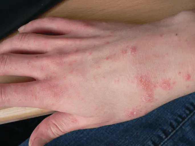 Children&#8217;s skin problems. Skin allergy, head lice, scabies