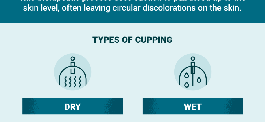 Chinese cupping &#8211; use, indications, contraindications, effects. When does cupping help? WE EXPLAIN