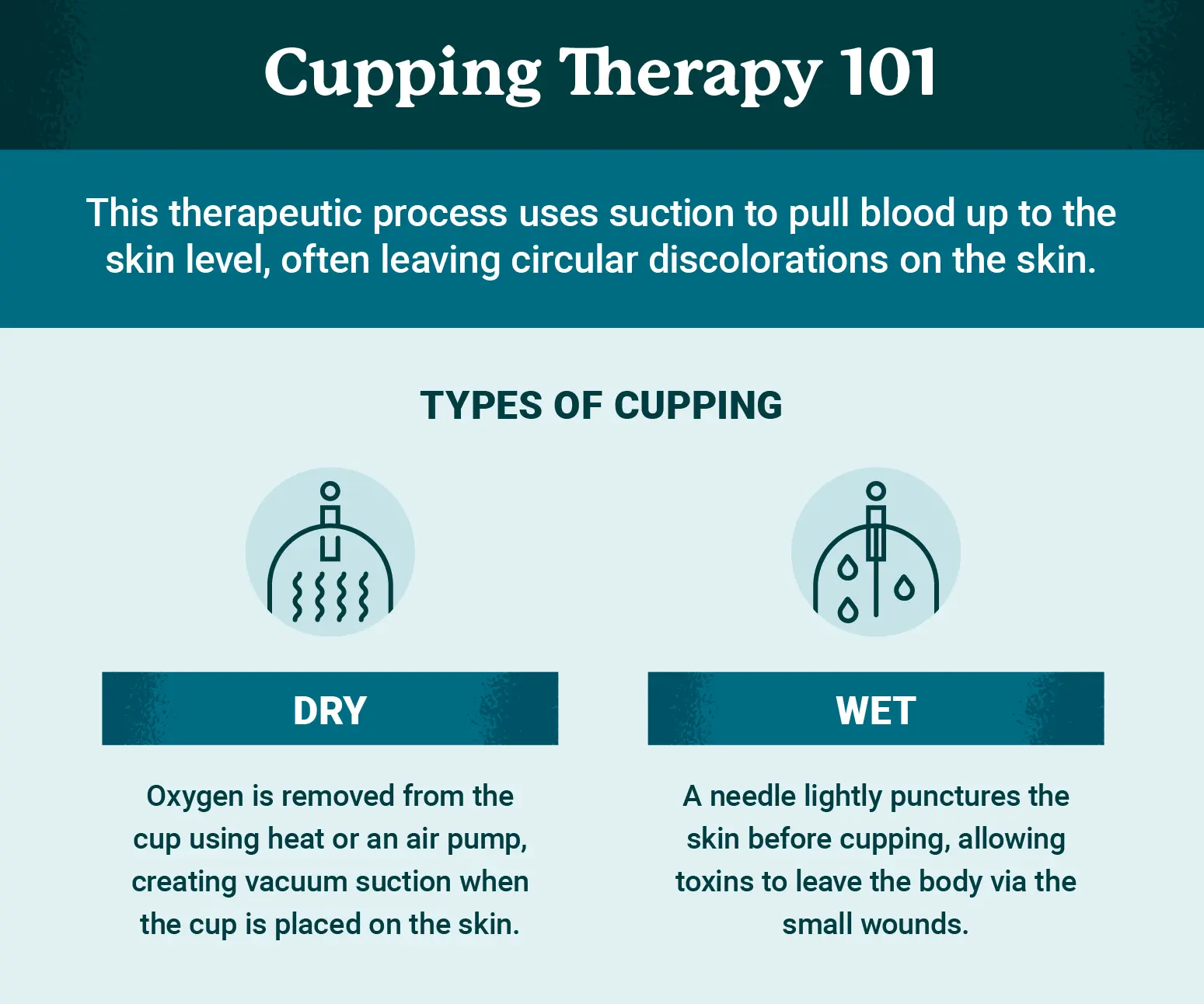 Chinese cupping &#8211; use, indications, contraindications, effects. When does cupping help? WE EXPLAIN