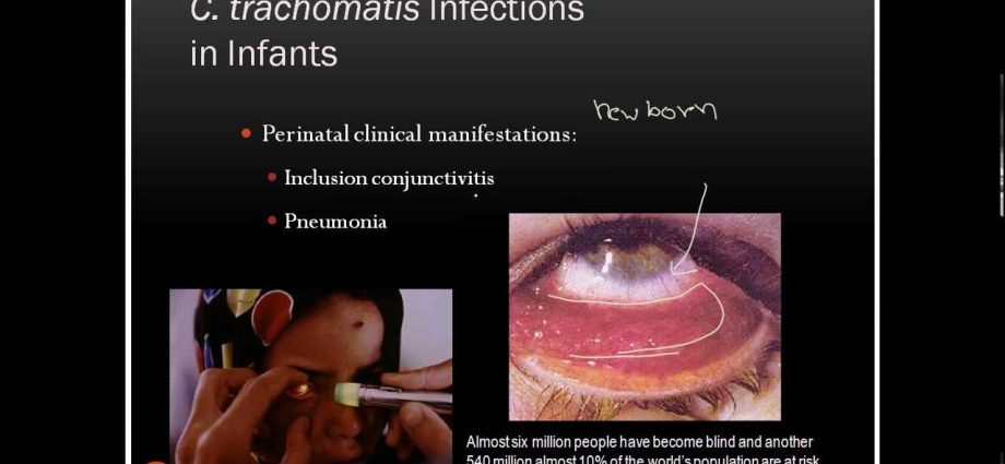 Chlamydia trachomatis &#8211; clinical signs of infection